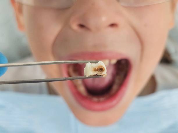 Best Knocked-Out Tooth (Avulsed Tooth) Treatment in Delafield, WI